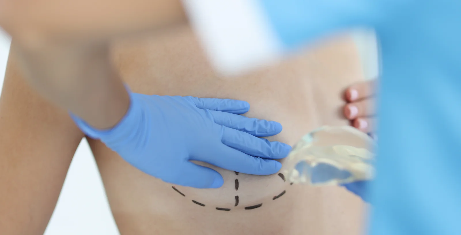 Explantación Mamaria