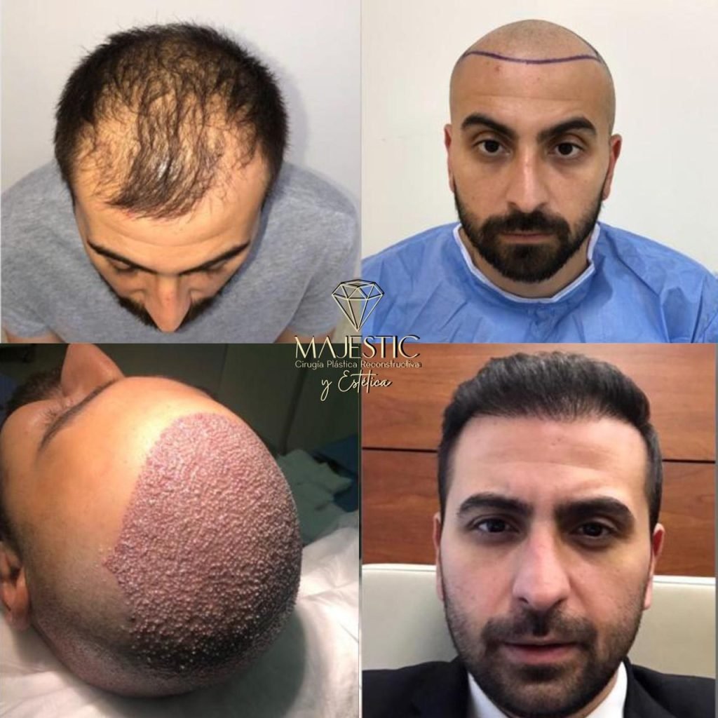 Implante capilar masculino Majestic Plastic Surgery