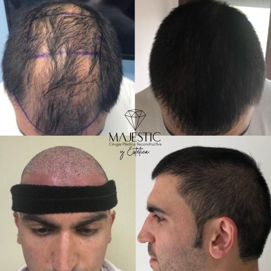 Implante capilar hombre realizado Majestic Plastic Surgery