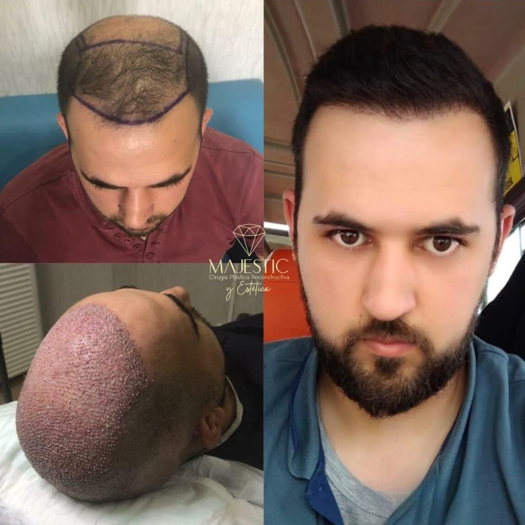 Implante capilar hombre antes y después de Majestic Plastic Surgery