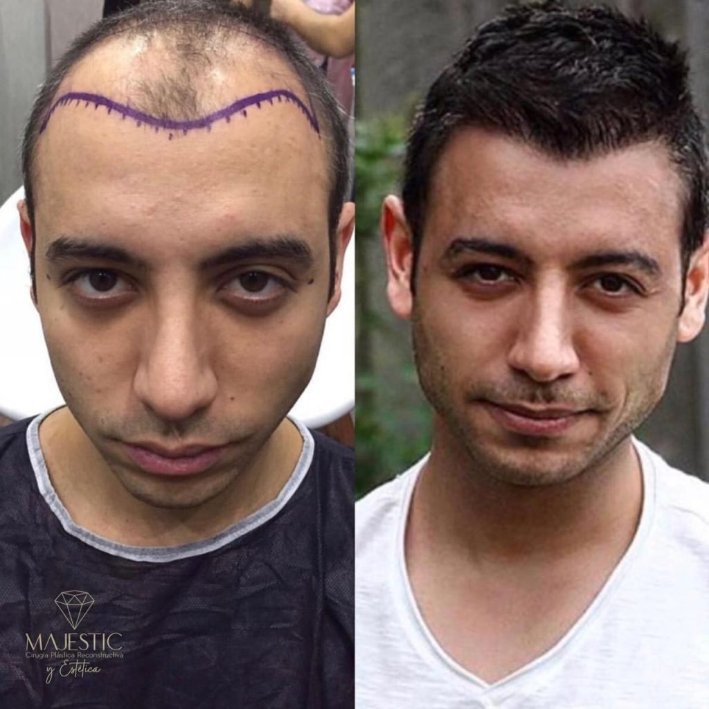 Implante capilar hombre antes y después de cirugía
