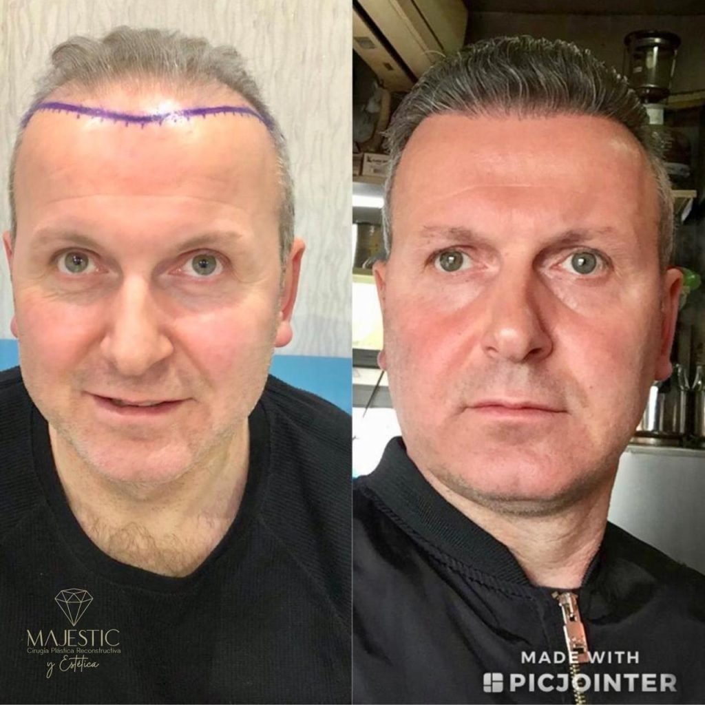 Implante capilar hombre Majestic Plastic Surgery