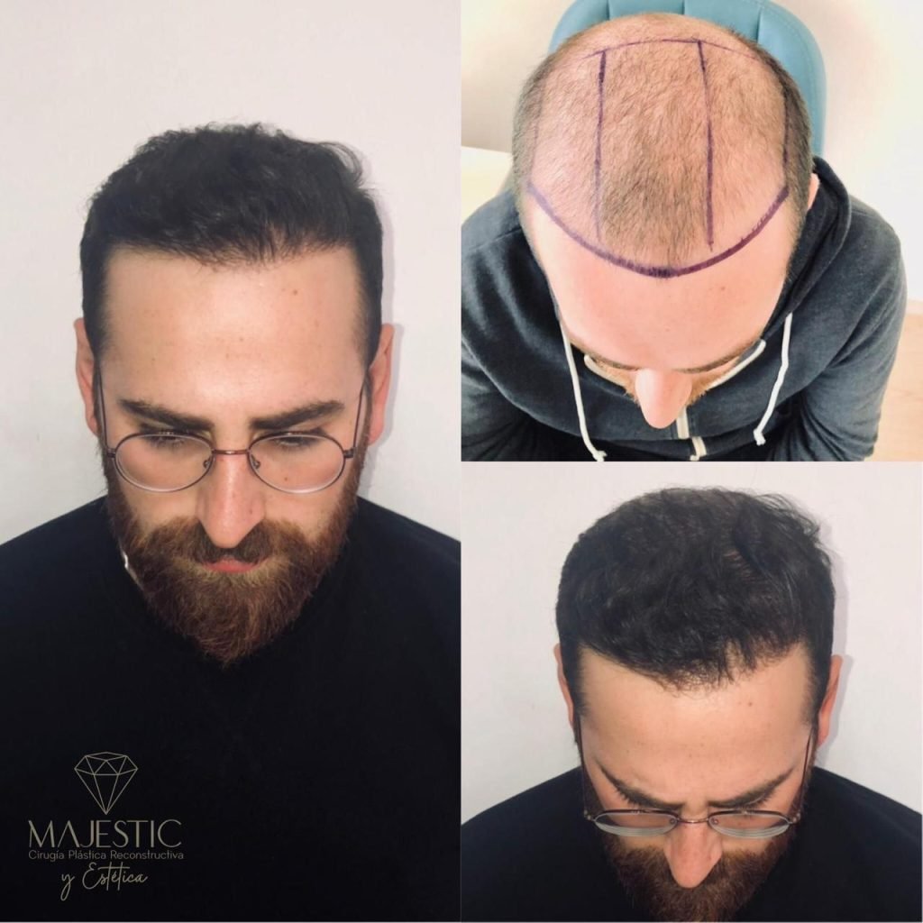 Implante capilar hombre antes y después