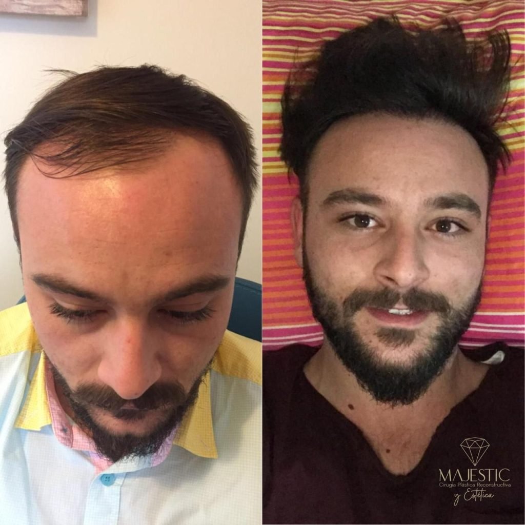 Implante capilar hombre joven