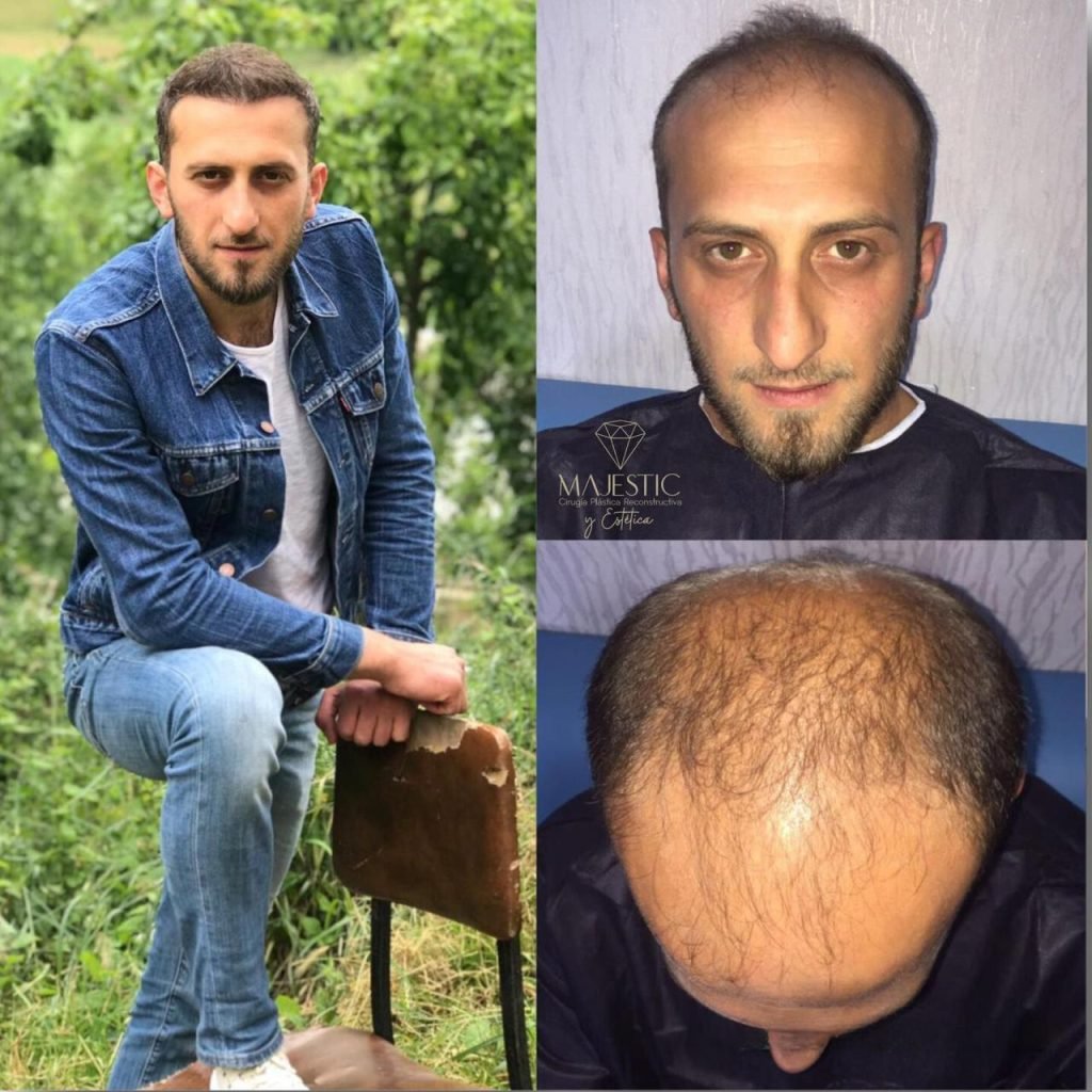 Implante capilar hombre